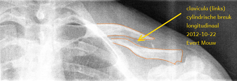 Röntgenfoto net na het ongeluk (2012-10-22) met daarop de claviculafractuur links goed zichtbaar.